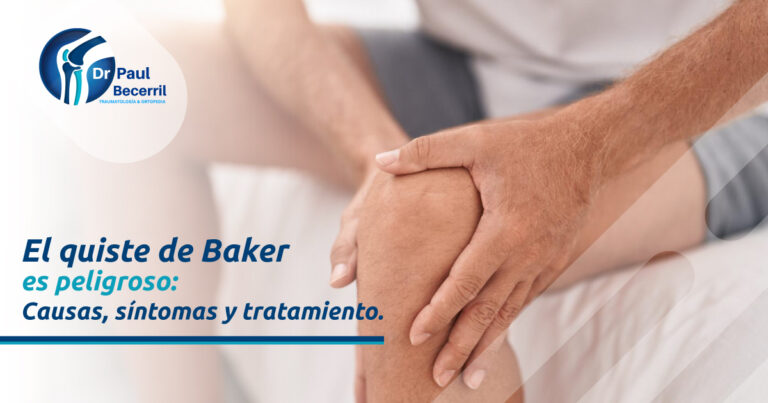 El quiste de Baker es peligroso